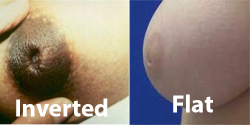flat and inverted nipples